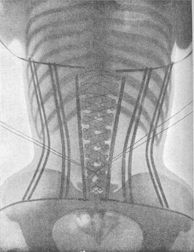The Corset X-Rays of Dr Ludovic O’Followell (1908)